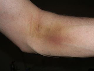 bruise.jpg